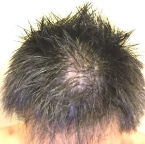 自分の頭が薄毛状態