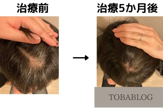AGA治療5カ月目の変化_TOBABLOG